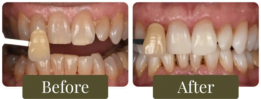 Before and after teeth whitening in Philadelphia, PA at Opus Dental Esthetics