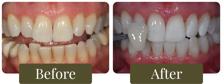 Before and after teeth whitening in Philadelphia, PA at Opus Dental Esthetics