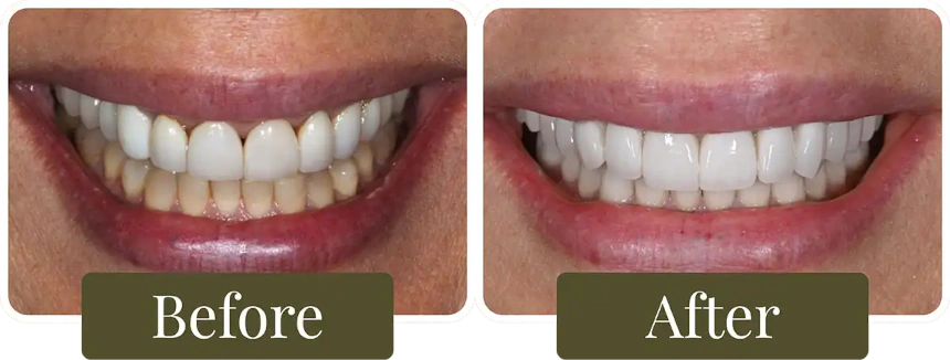 Before and after dental crowns in Philadelphia, PA at Opus Dental Esthetics
