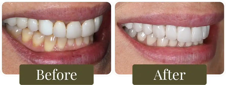 Before and after dental crowns in Philadelphia, PA at Opus Dental Esthetics