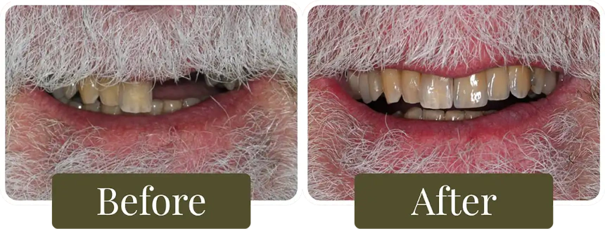 Before and after dental crowns in Philadelphia, PA at Opus Dental Esthetics