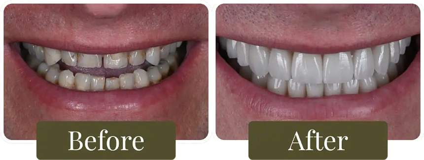 Before and after dental crowns in Philadelphia, PA at Opus Dental Esthetics