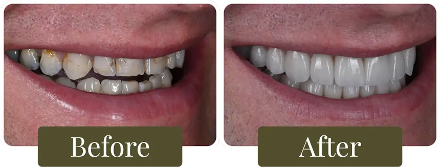 Before and after dental crowns in Philadelphia, PA at Opus Dental Esthetics