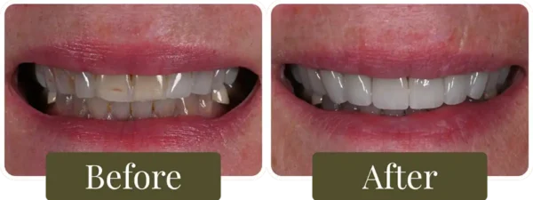 Dental-Veneers-Before-After-04-Opus-Dental-860x326 Before and after dental veneers in Philadelphia, PA at Opus Dental Esthetics