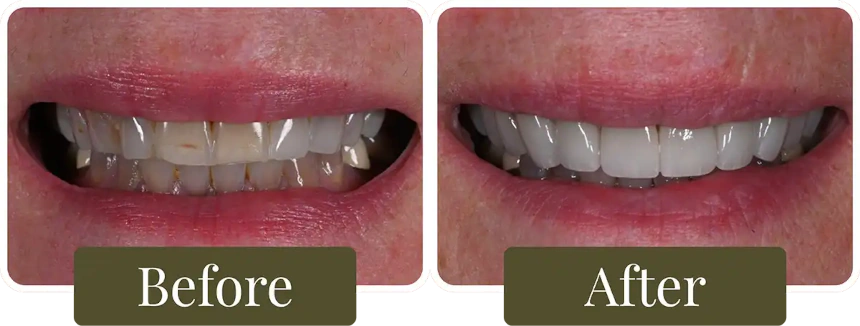 Before and after dental veneers in Philadelphia, PA at Opus Dental Esthetics