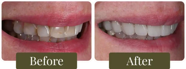 Dental-Veneers-Before-After-05-Opus-Dental-860x326 Before and after dental veneers in Philadelphia, PA at Opus Dental Esthetics