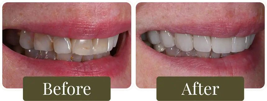 Before and after dental veneers in Philadelphia, PA at Opus Dental Esthetics