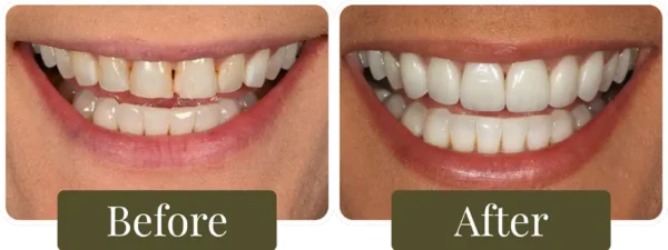 Dental-Veneers-Before-After-06-Opus-Dental-860x326 Before and after dental veneers in Philadelphia, PA at Opus Dental Esthetics
