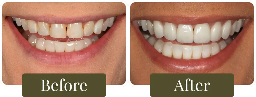 Before and after dental veneers in Philadelphia, PA at Opus Dental Esthetics