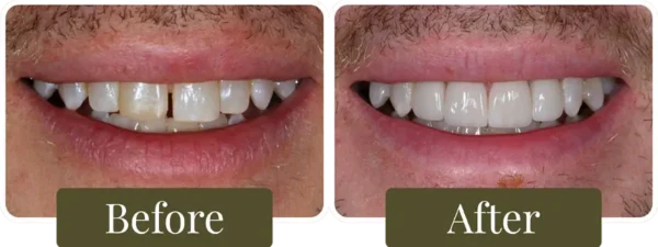 Dental-Veneers-Before-After-07-Opus-Dental-860x326 Before and after dental veneers in Philadelphia, PA at Opus Dental Esthetics