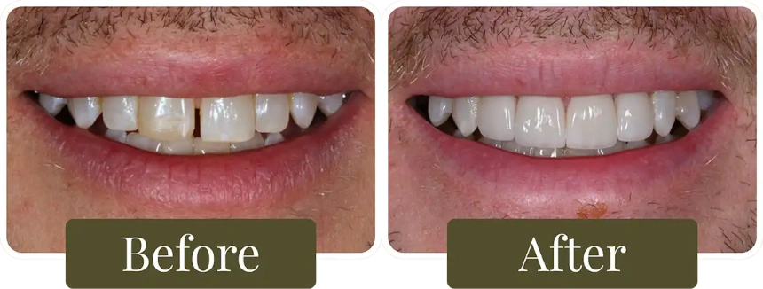 Before and after dental veneers in Philadelphia, PA at Opus Dental Esthetics