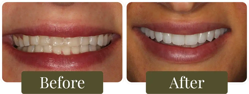 Before and after a Smile Makeover in Philadelphia, PA at Opus Dental