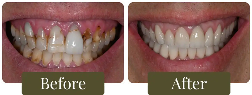 Before and after a Smile Makeover in Philadelphia, PA at Opus Dental