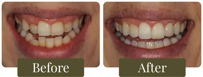 Before and after a Smile Makeover in Philadelphia, PA at Opus Dental