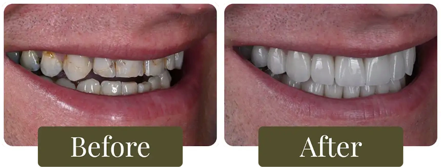 Before and after a Smile Makeover in Philadelphia, PA at Opus Dental