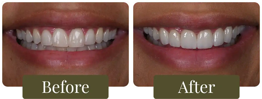 Before and after a Smile Makeover in Philadelphia, PA at Opus Dental