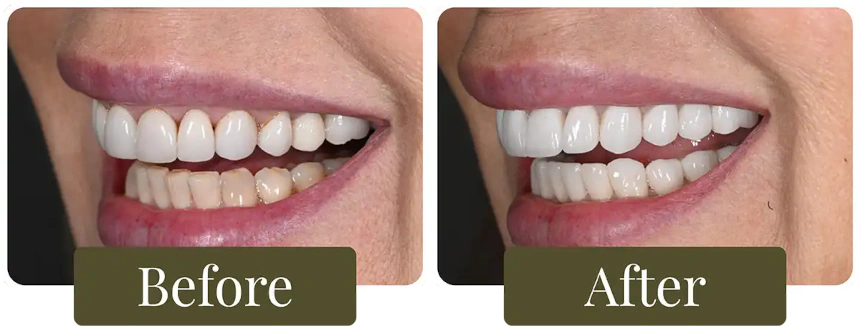 Before and after a Smile Makeover in Philadelphia, PA at Opus Dental